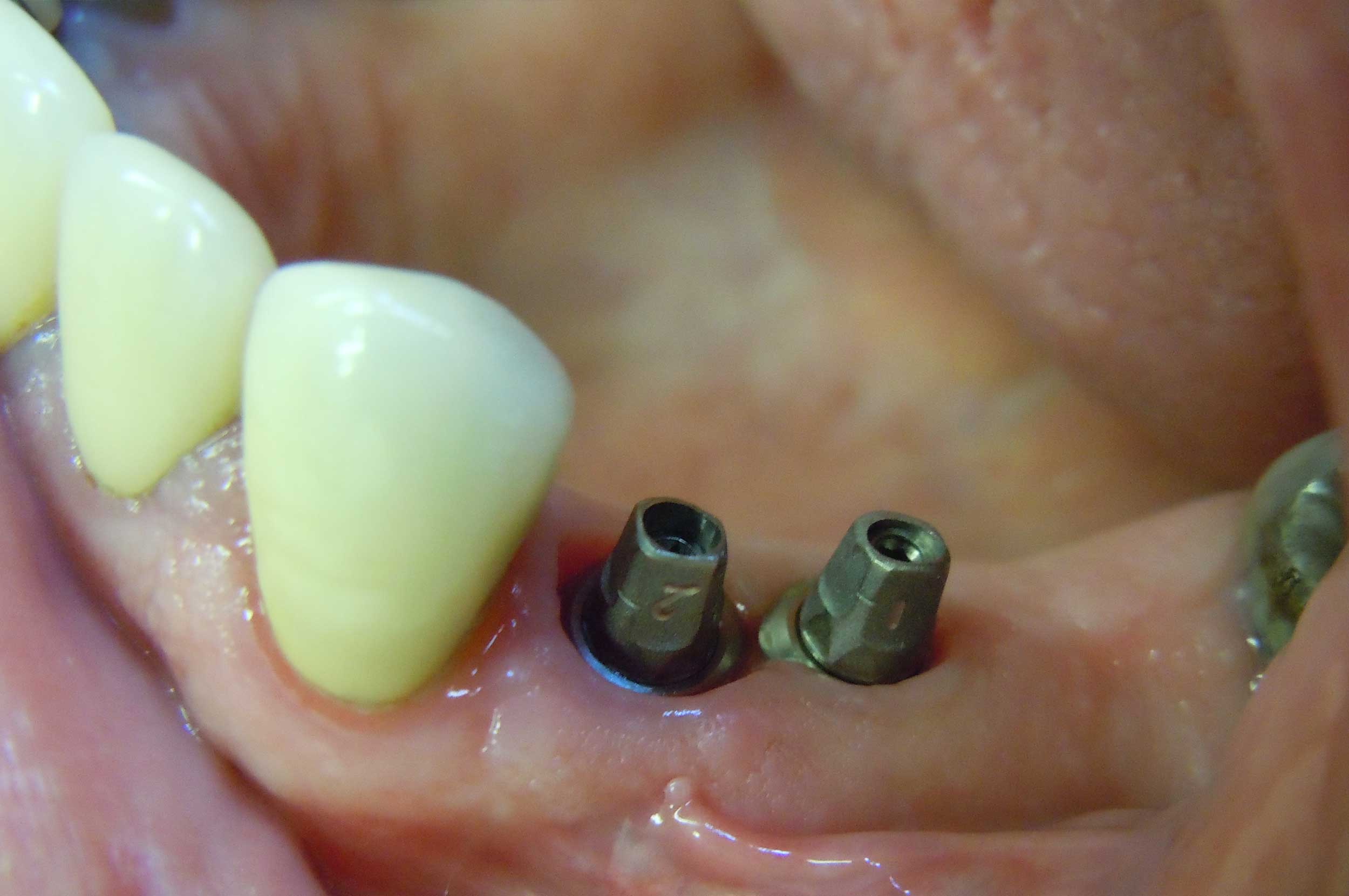 Dental Implant treatment